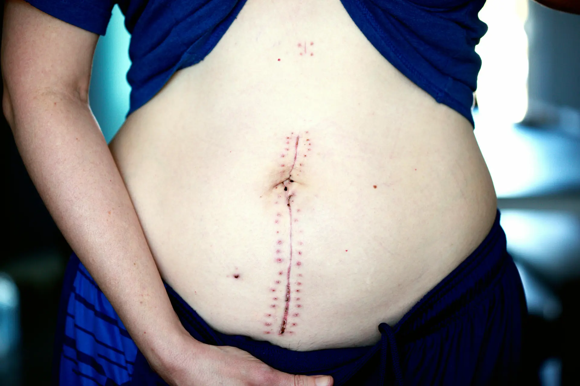 Manual Lymphatic Drainage for Post Surgery: A Gentle Path to Faster Healing